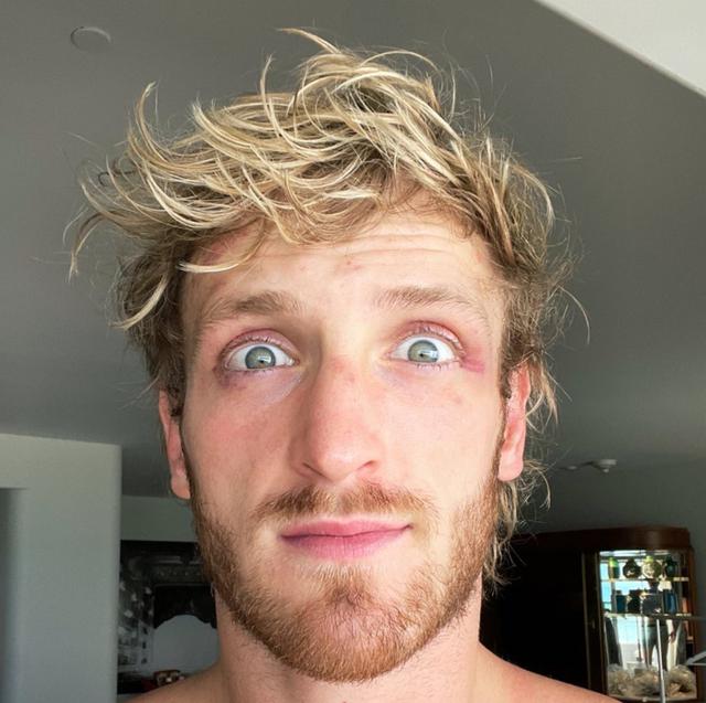 The hairline of Logan Paul